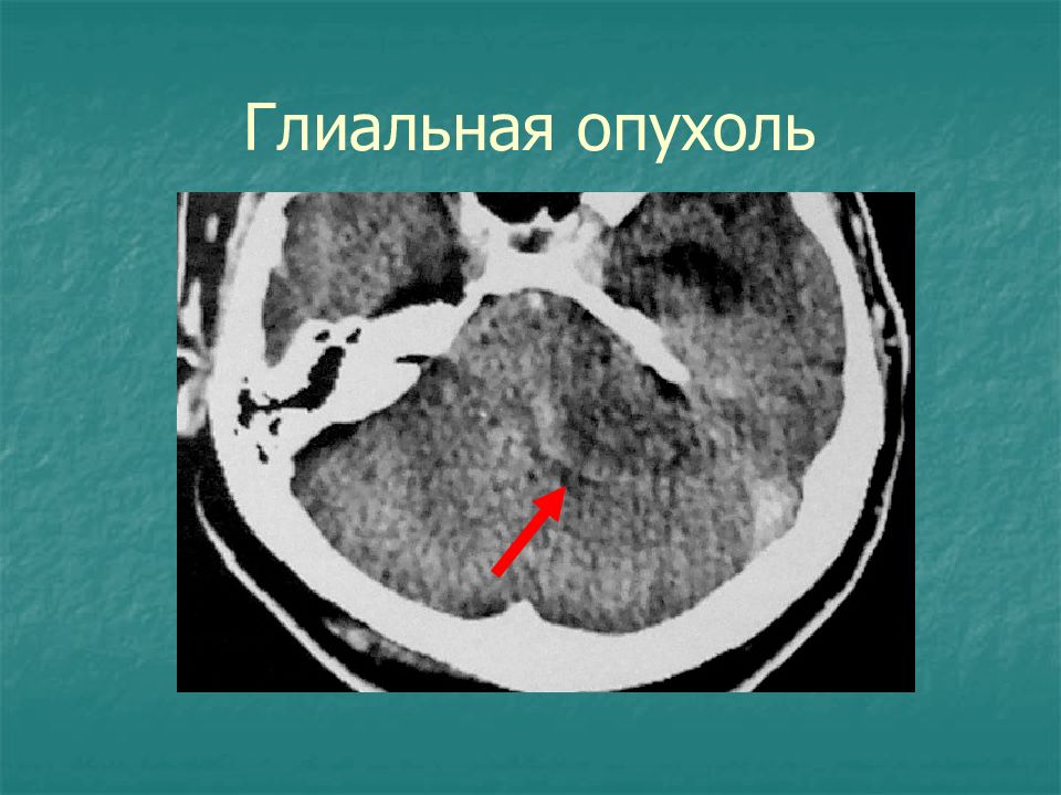 Глиальная опухоль головного. Глиальная опухоль головного мозга кт. Глиальная опухоль височной доли.