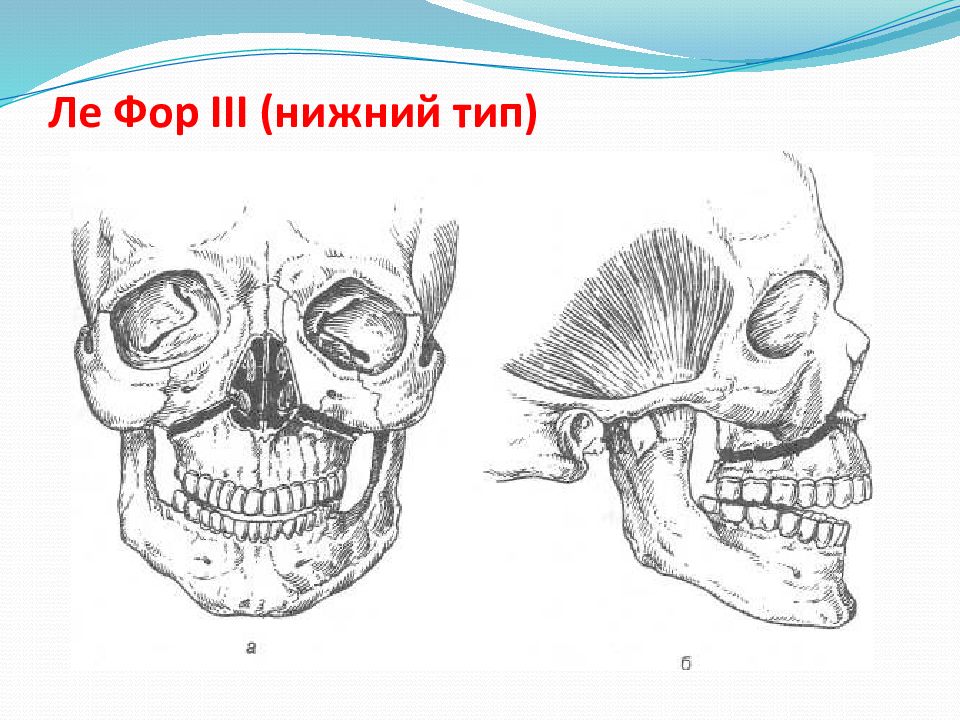 Переломы челюстей презентация