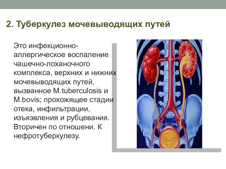 Туберкулез почек и мочевыводящих путей презентация