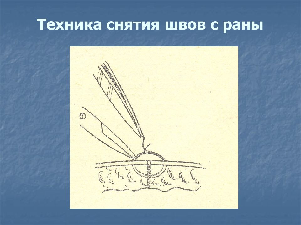 Швы сняты. Техника снятия кожных швов. Снятие хирургических швов алгоритм.