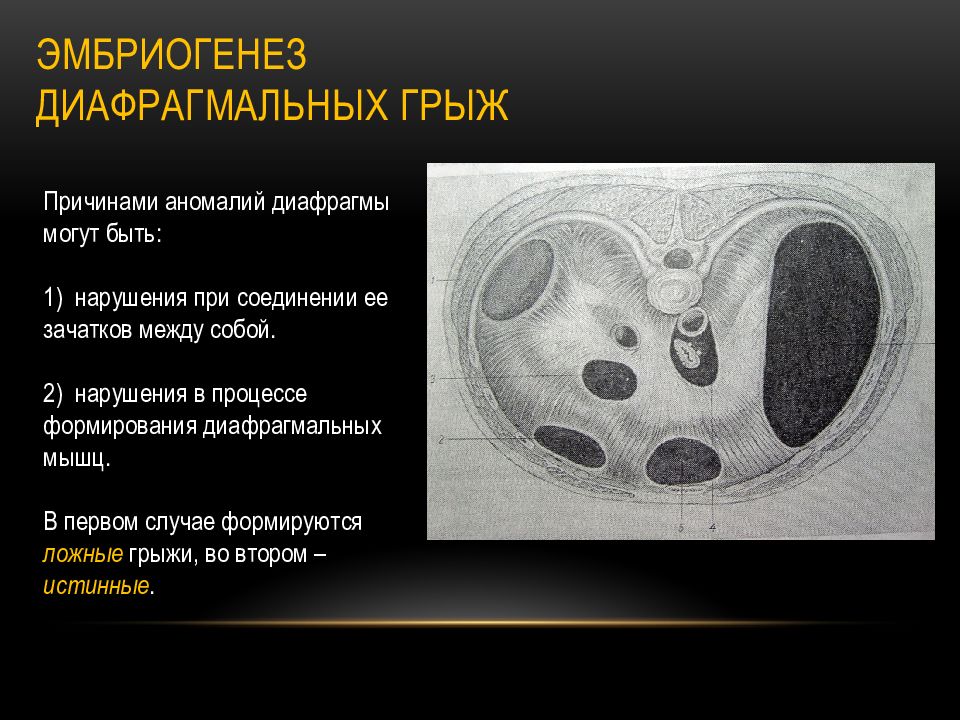 Врожденная диафрагмальная грыжа презентация