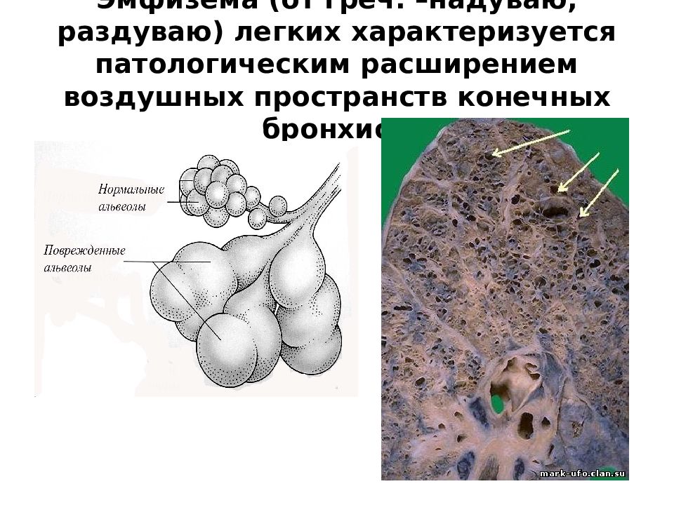 Эмфизема легких что это такое. Альвеолярная эмфизема. Эмфизема легких характеризуется:.