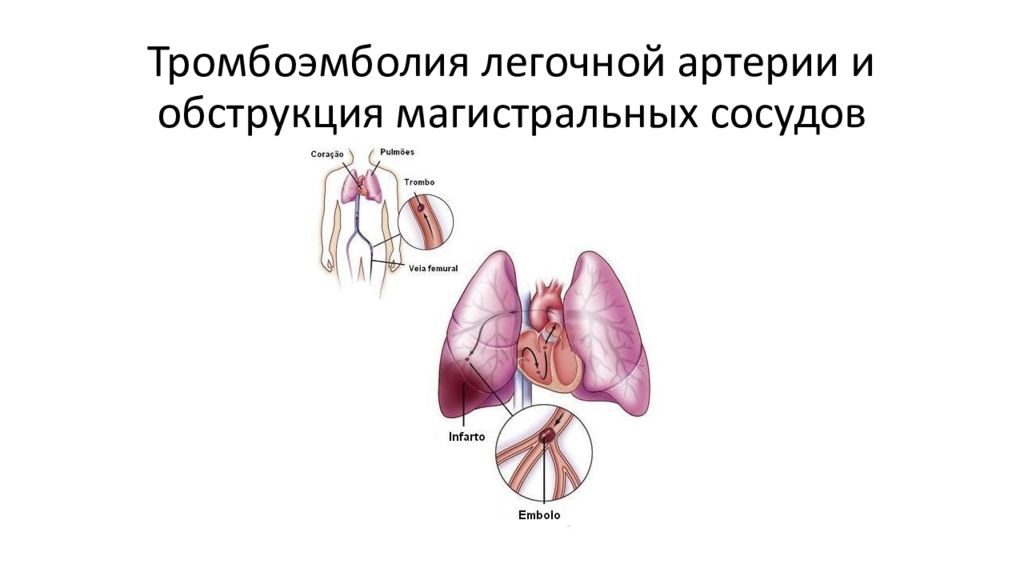 Тромбоэмболия легочной артерии пневмония. Обструкция легочных артерий. Легочная тромбоэмболия. Тэла картинки для презентации. Тромболия легочной артерии.