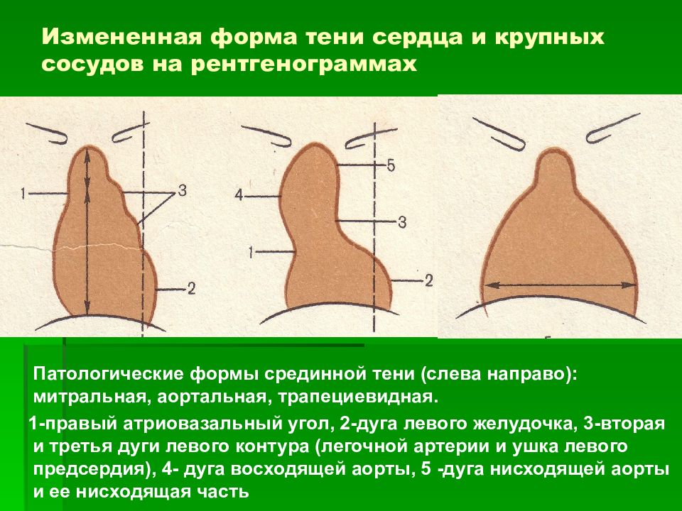 Тени сердца. Конфигурации сердечной тени. Изменение формы сердца. Патологические формы сердца. Формы сердца на рентгенограмме.