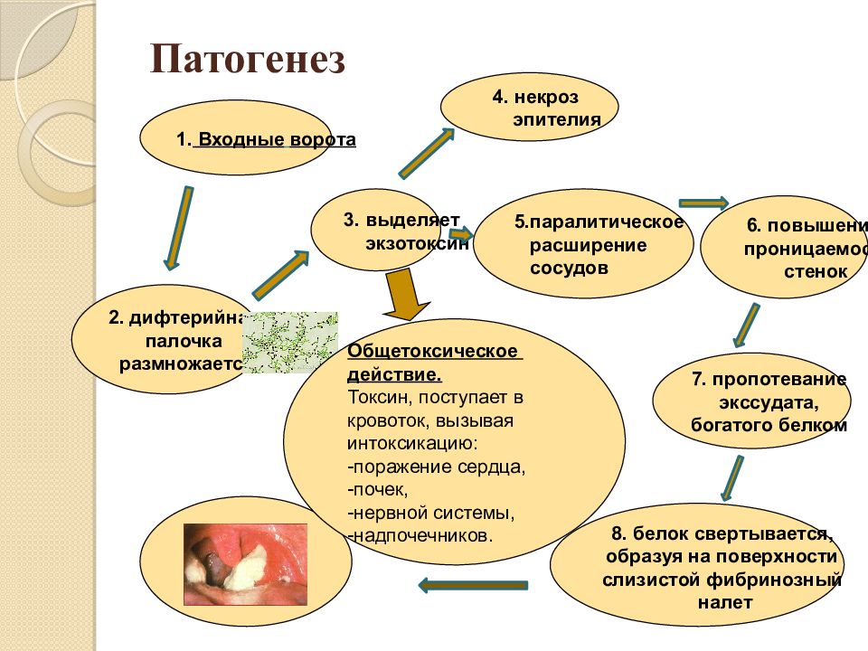 Патогенез дифтерии схема