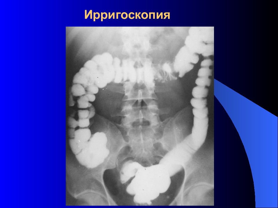 Ирригография кишечника. Долихосигма ирригоскопия. Исследование толстой кишки ирригоскопия. Ирригоскопия брюшной полости. Контрастная ирригоскопия.