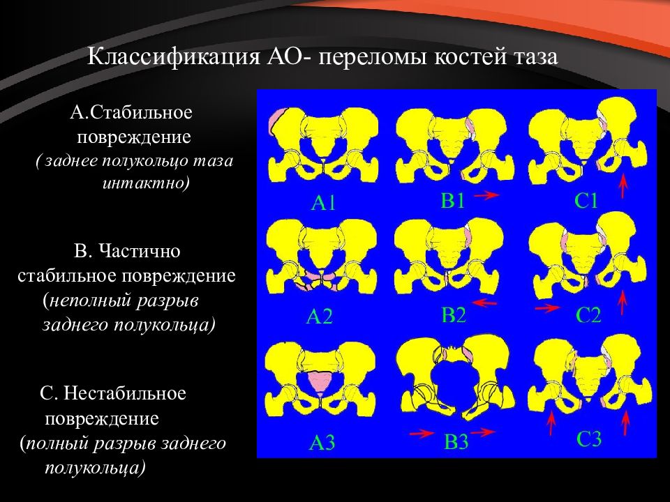 Повреждения таза презентация