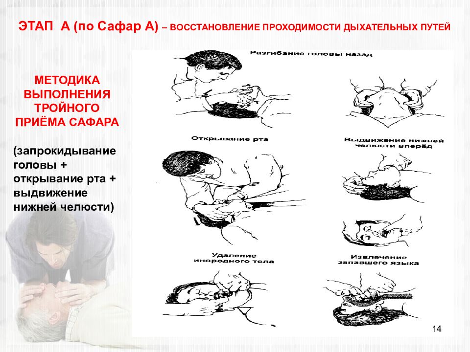 Восстановление проходимости путей. Обеспечение проходимости дыхательных путей тройной прием Сафара. Этапы восстановления проходимости дыхательных путей. Этапы тройного приема Сафара. Этапы выполнения тройного приема Сафара.