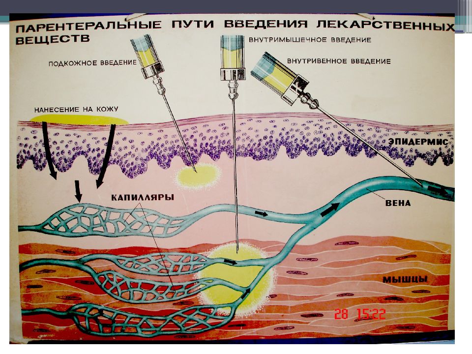 Парентеральное введение лекарственных средств. Парентеральное Введение это. Парентеральный способ введения лекарственных. Парентеральные пути введения лекарственных веществ.