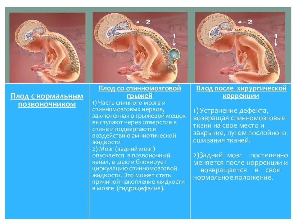 Фетальная хирургия. Внутриутробные пороки развития. Пороки развития у зародышей. Внутриутробная операция. Пороки развития и заболевания плода.