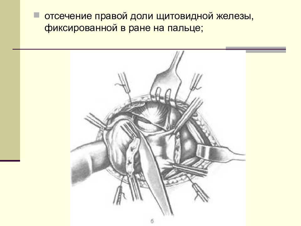 Сколько длится операция щитовидной