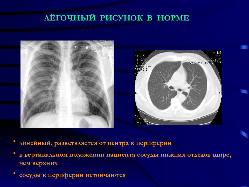 Отделы легочного рисунка. Легочный рисунок в норме. Сгущение легочного рисунка. Легочный рисунок сгущен. Легочный рисунок в норме от центра к периферии.