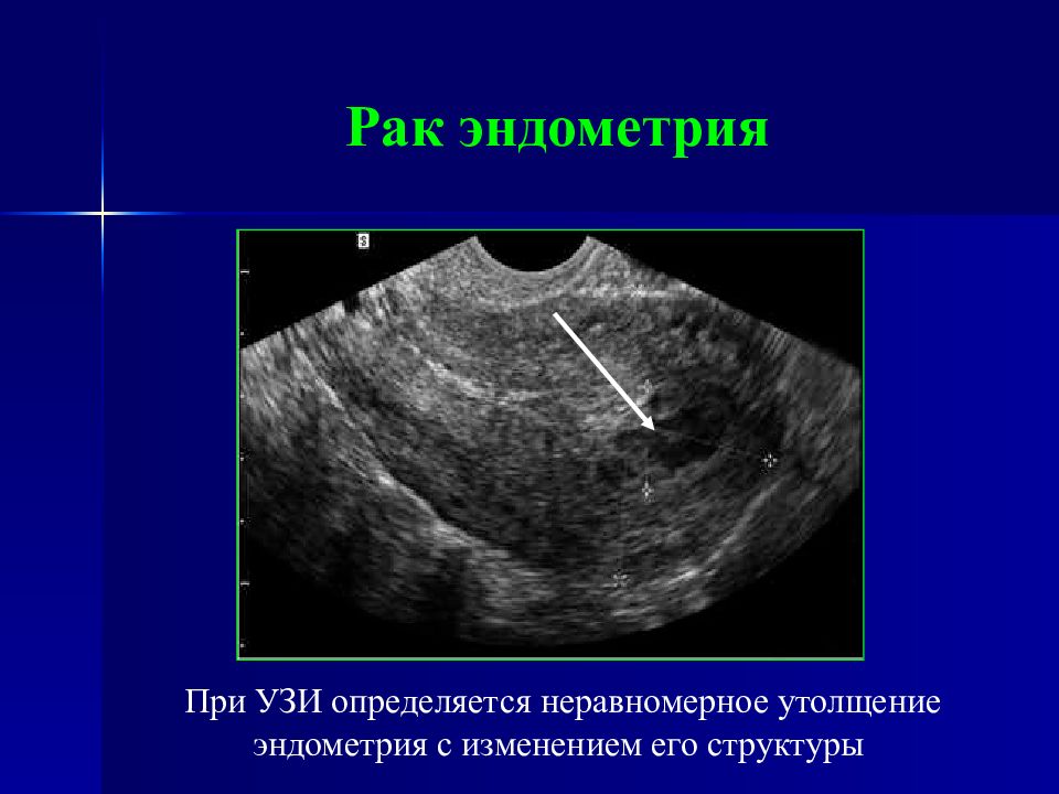 Эндометрия 21. Гиперплазия эндометрия на УЗИ. Структура эндометрия на УЗИ.