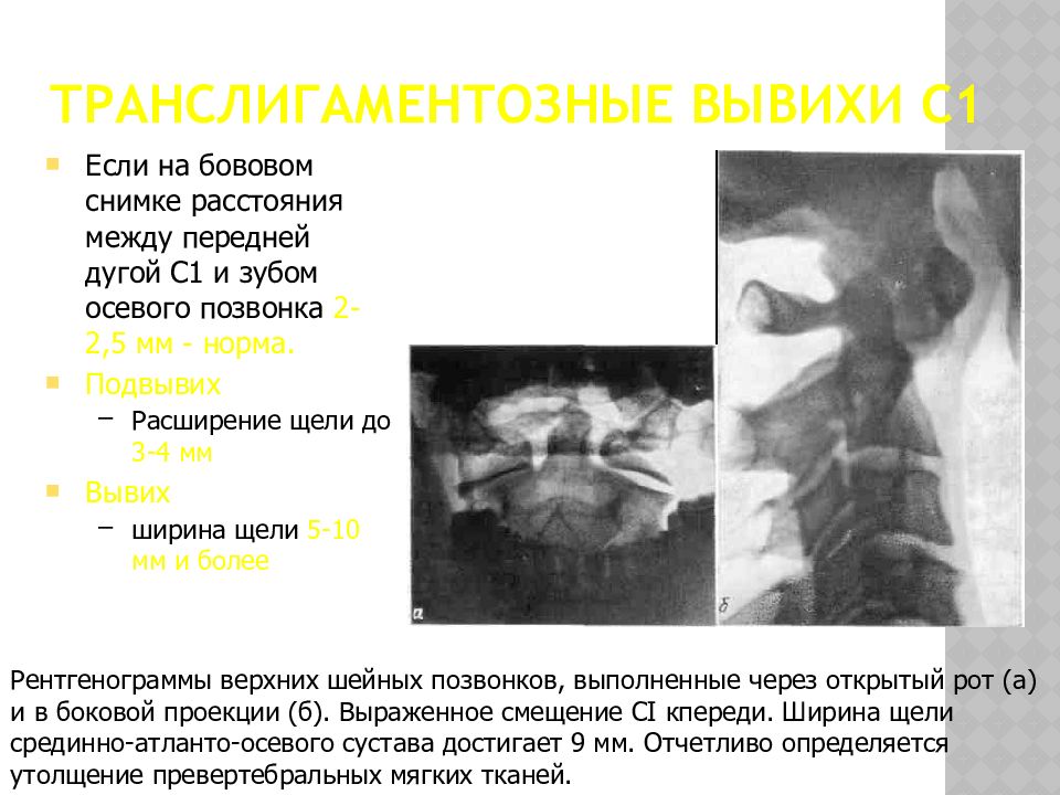 Подвывих позвонка. Ротационный подвывих с1 позвонка на рентгене. Атлант подвывих первого шейного позвонка. Подвывих Атланта кт. Ротационный подвывих Атланта рентген.