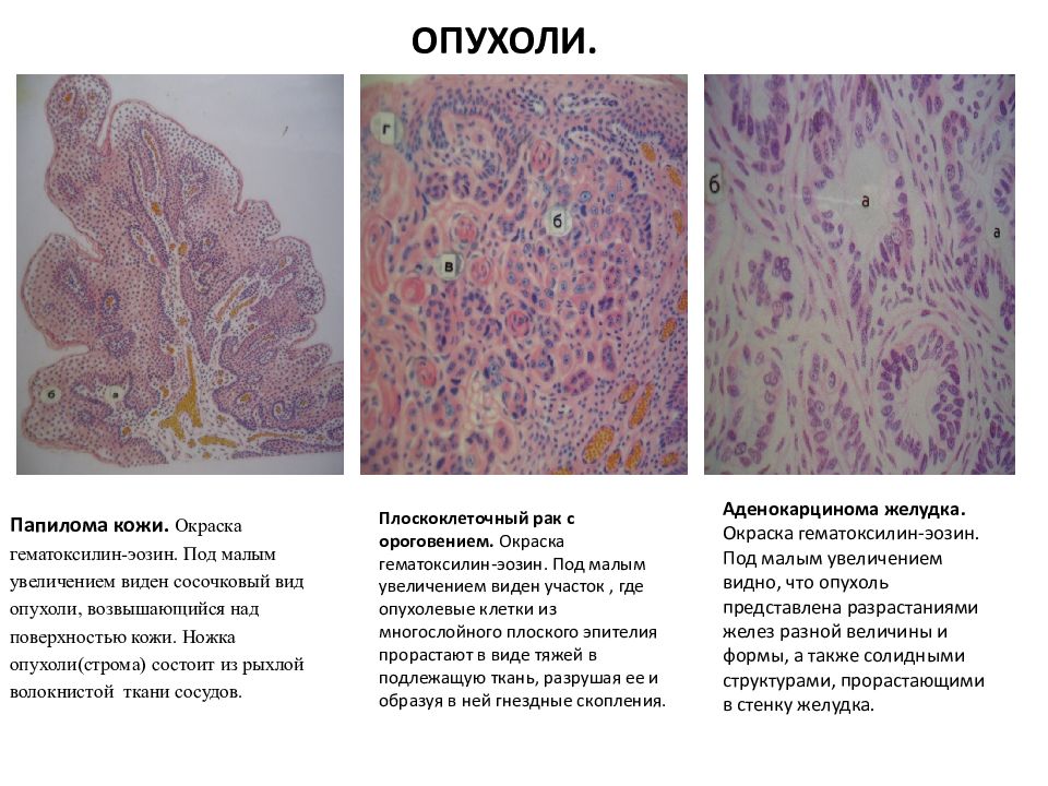 Микропрепарат аденокарцинома желудка рисунок