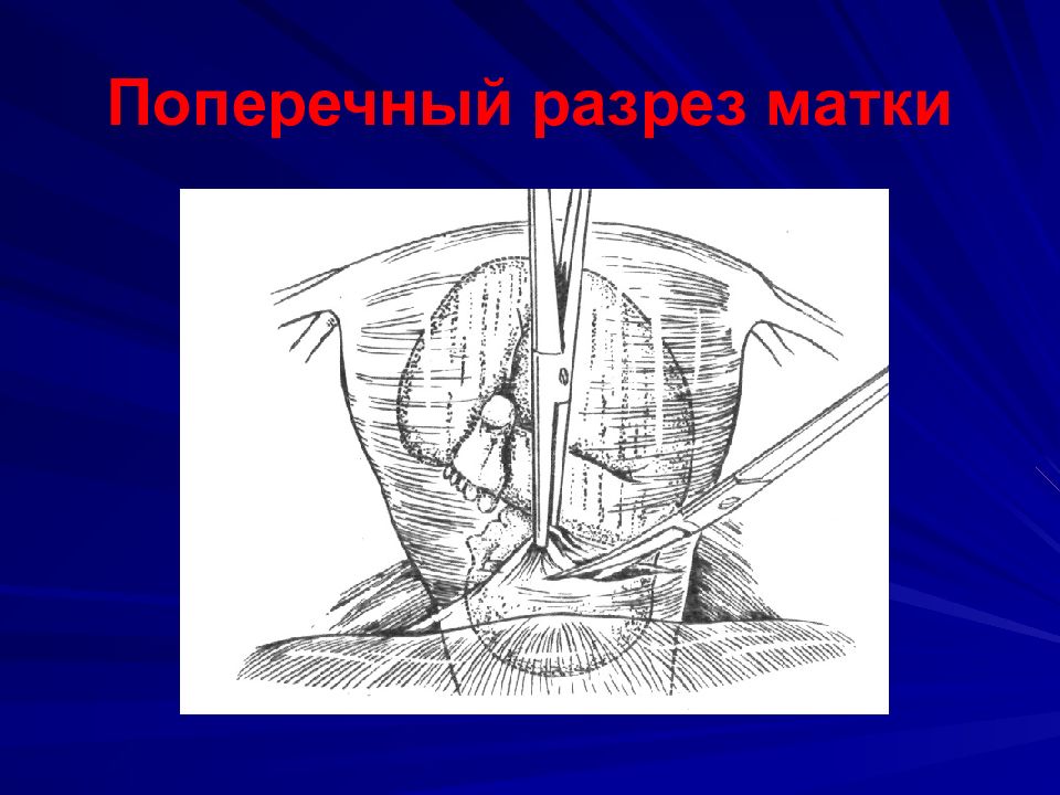 Наркоз матки. Кесарево сечение топографическая анатомия. Вертикальный разрез кесаревом сечении. Разрез при кесаревом сечении. Вертикальный разрез при кесаревом сечении.