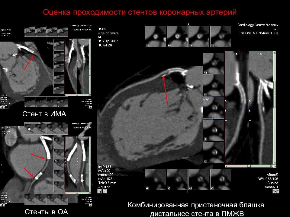 Кт скрининг коронарного кальция