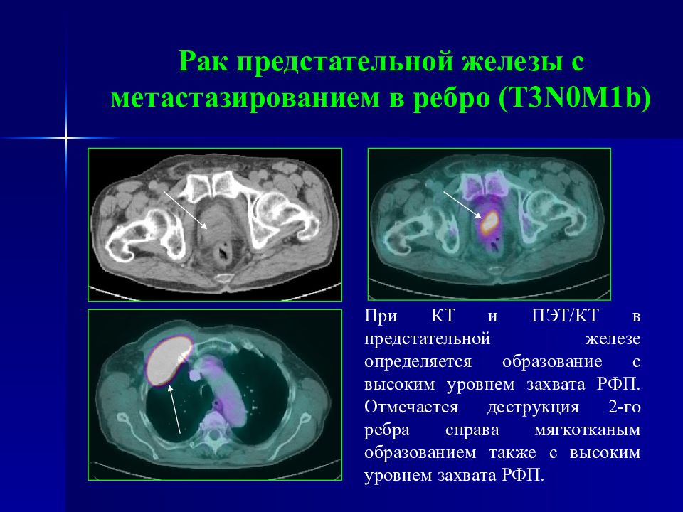 Рак предстательной железы метастазы прогноз. Метастазы предстательной железы на кт. Метастазы предстательной железы в кости. Метастазы в предстательной железе. Рентгенодиагностика онкологии.