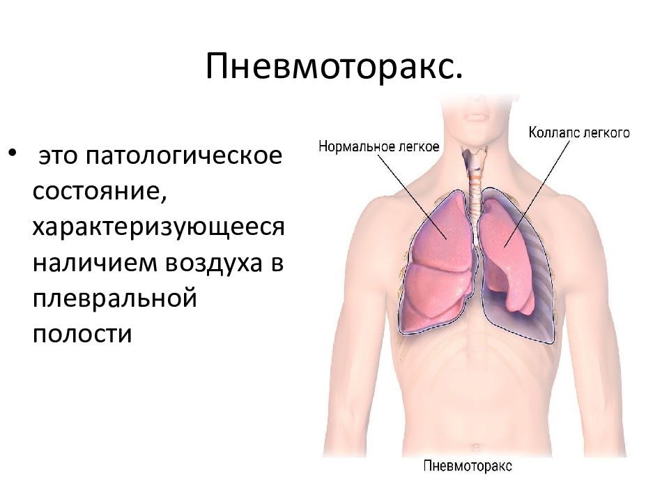 Закрытый пневмоторакс