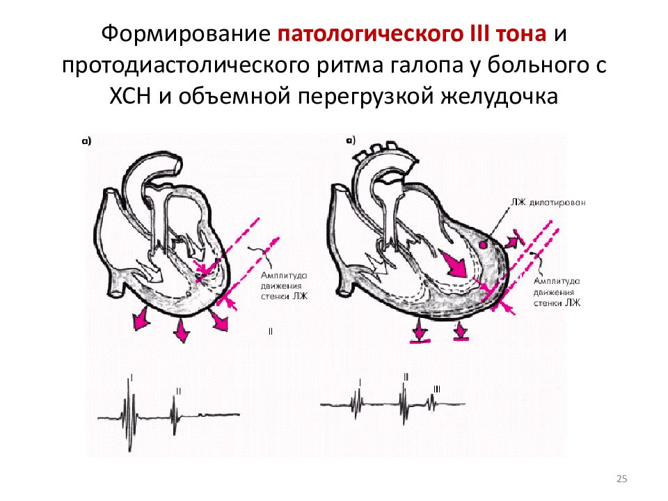 Ритм галопа при каком заболевании. Ритм галопа митральная недостаточность. Ритм галопа при аортальной недостаточности. Ритм галопа механизм образования. Ритм галопа при митральной недостаточности.