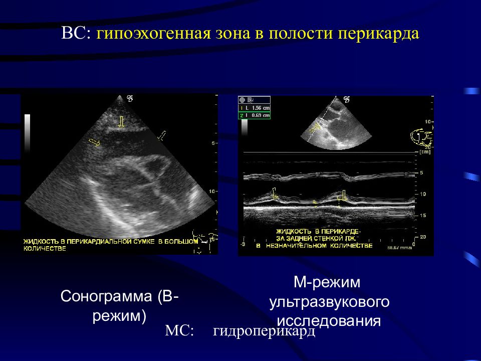 Жидкость в перикарде. Гидроперикард на ЭХОКГ. ЭХИКГ гидроперикард 4 мм. ЭХОКГ норма жидкости в перикарде. Измерение жидкости в перикарде на ЭХОКГ.