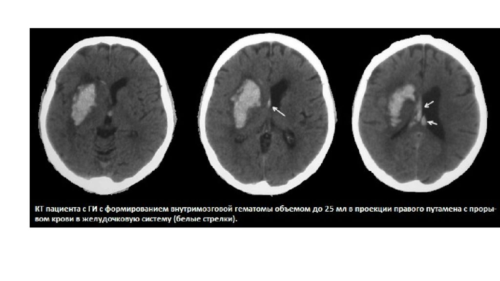Гематома головного мозга рассасывается. Геморрагический инсульт МР сигнал. Геморрагический инсульт на вскрытии. Повторный геморрагического инсульта и операции.