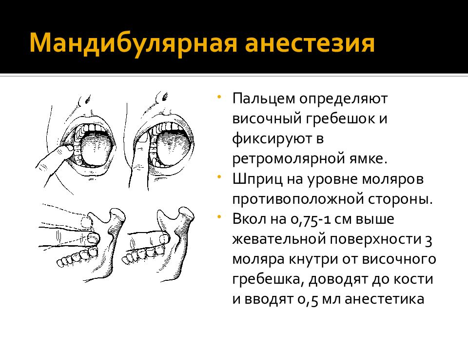 Мандибулярная анестезия в стоматологии схема проведения видео