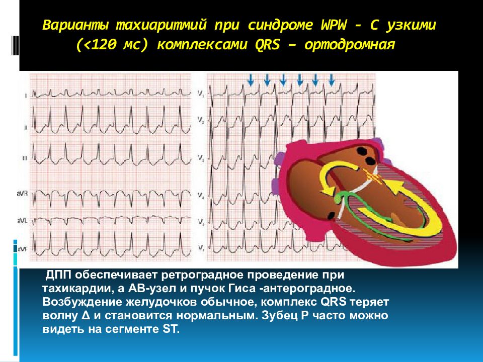 Пароксизмальная тахиаритмия. Тахиаритмии с узким комплексом QRS. Тахикардия с узкими комплексами QRS. ЭКГ при тахиаритмии. Ортодромная пароксизмальная тахикардия при синдроме wpw.