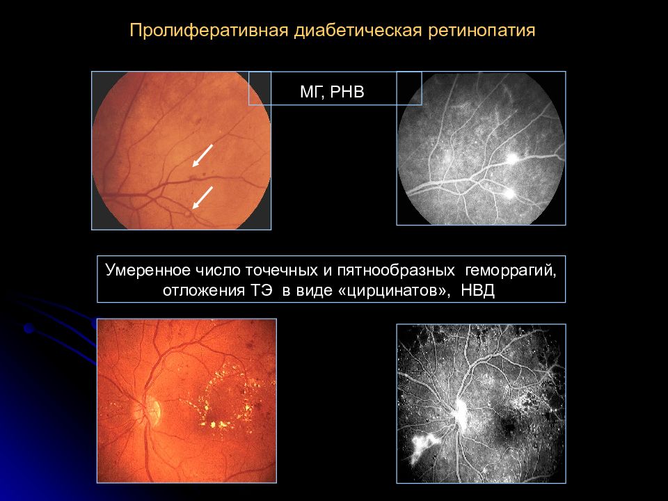 Диабетическая ретинопатия это. Пролиферативная ретинопатия. Пролиферативная стадия диабетической ретинопатии. Пролиферативная фаза ретинопатия. Флуоресцентная ангиография диабетическая ретинопатия.