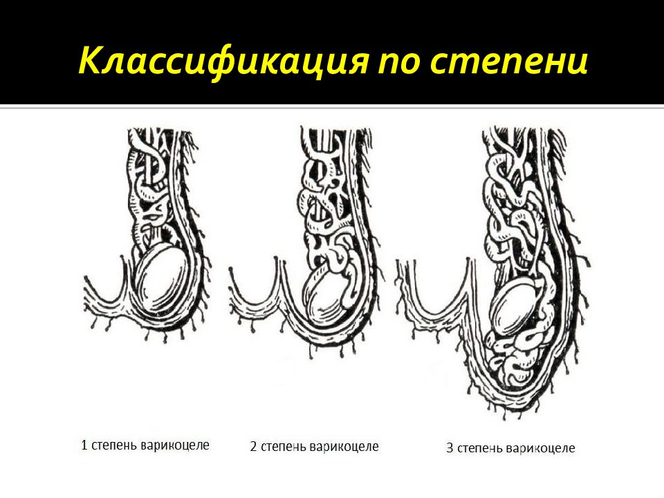 Левостороннее варикоцеле