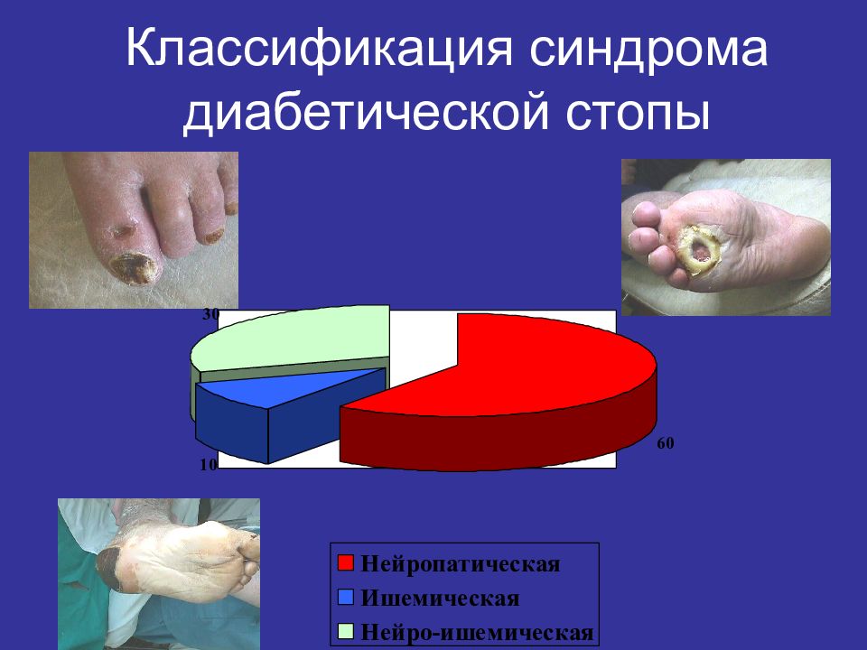 Диабетическая стопа рекомендации