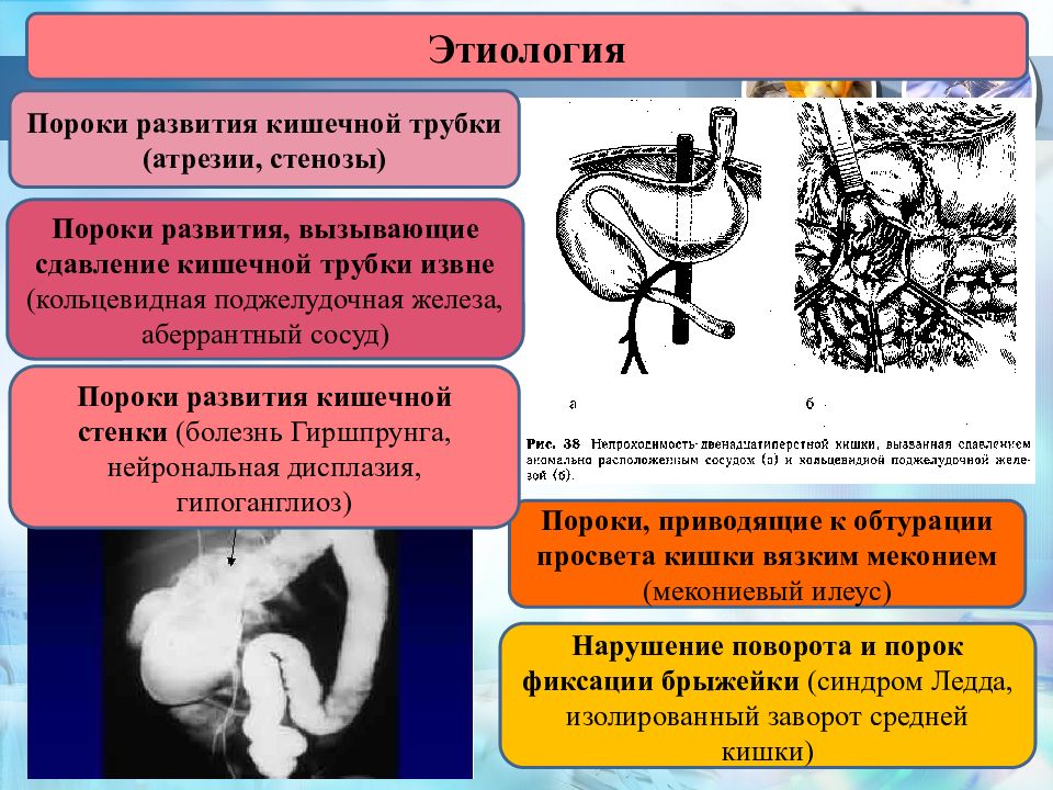 Борется с пороками. Пороки развития пищеварительной трубки. Пороки пищеварительного тракта. Пороки развития ЖКТ новорожденных. Пороки развития пищеварительного тракта у детей.