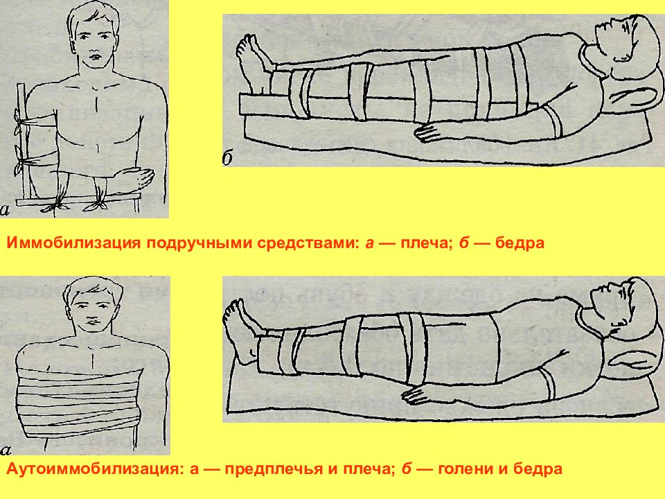 Иммобилизация это. Иммобилизация подручными средствами. Иммобилизация голени и бедра. Иммобилизация при переломе бедра. Иммобилизация конечностей подручными средствами.