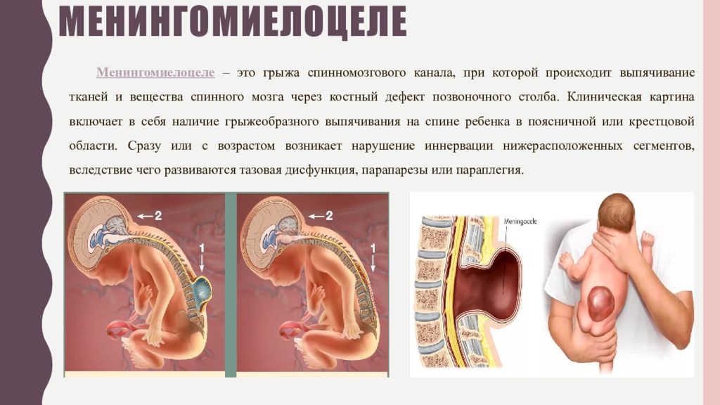 Эмбриональные грыжи презентация