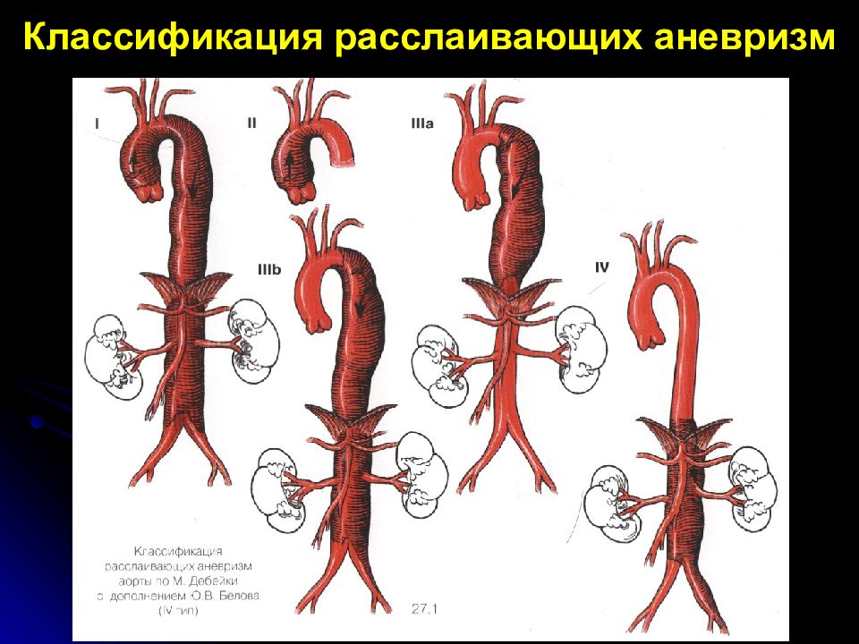 Аневризма аорты это. Классификация аневризм аорты. Классификация аневризм брюшной аорты по Дебейки. Аневризма брюшной аорты классификация. Аневризма грудного отдела аорты классификация.