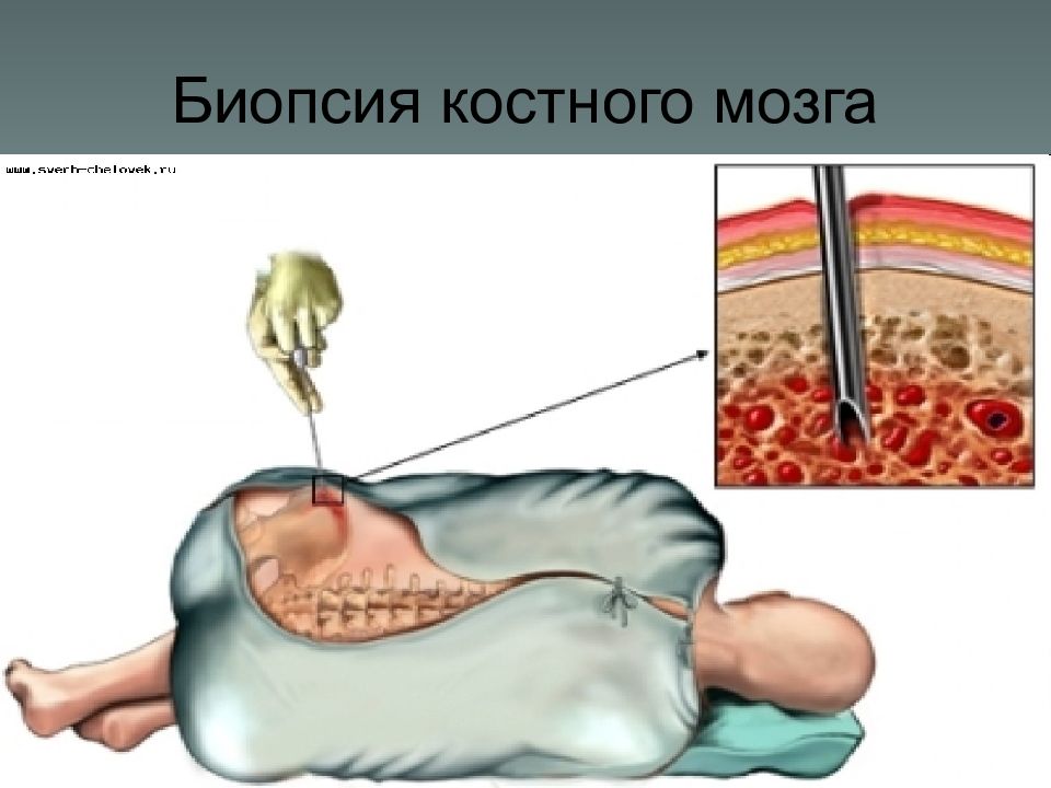 Костный мозг болит. Трепанобиопсия костного мозга. Трепанобиопсия при лейкозе. Пункционная биопсия костного мозга.