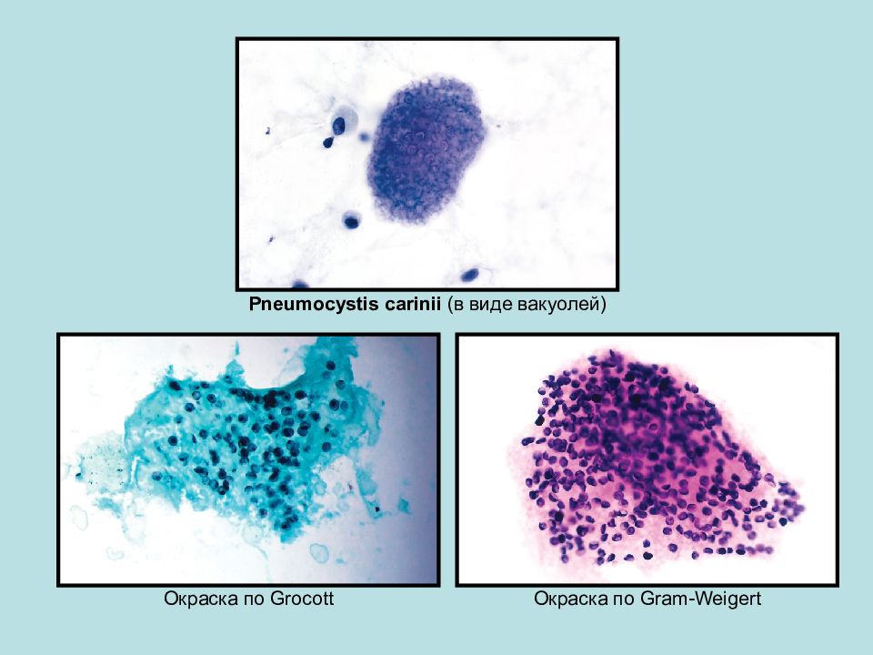Пневмоцисты. Пневмоцистис Каринии. Пневмоцисты окраска. Пневмоцисты цитология.