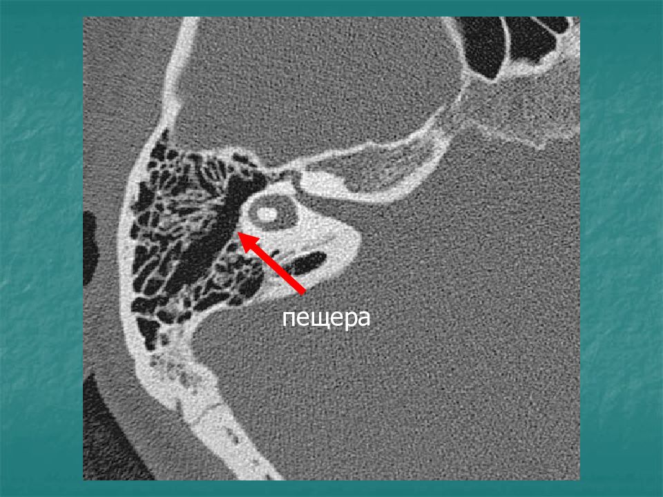 Пирамида височной кости кт