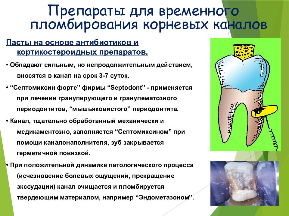 Временная паста для пломбирования каналов. Паста для временного пломбирования каналов. Медикаментозная обработка корневых каналов. Пломбирование каналов кальцийсодержащим препаратом. Временное пломбирование корневых каналов.