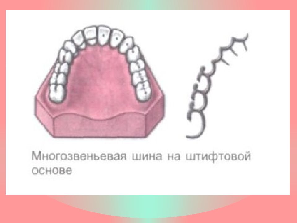 Постоянное шинирование при заболеваниях пародонта презентация