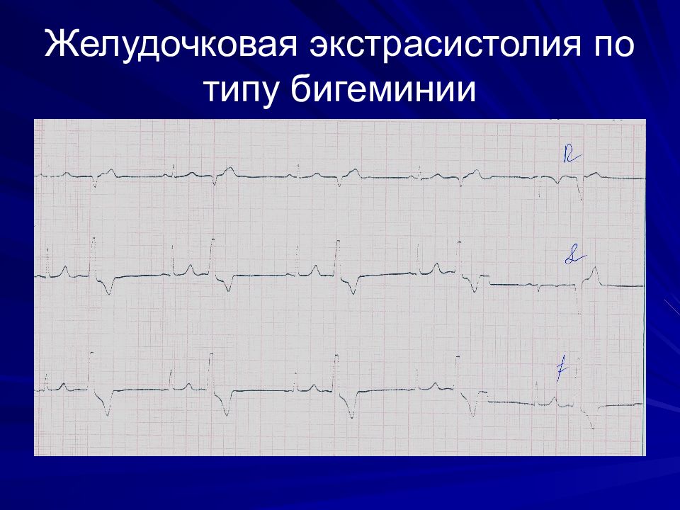 Нарушение ритма по типу бигеминии карта вызова