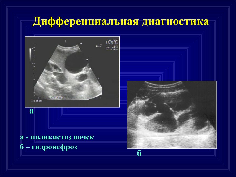 Узи картина гидронефроза почек