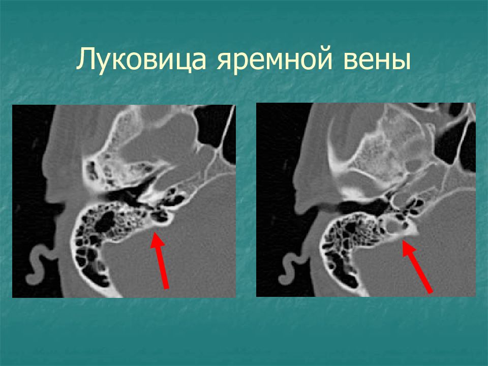 Пирамида височной кости кт