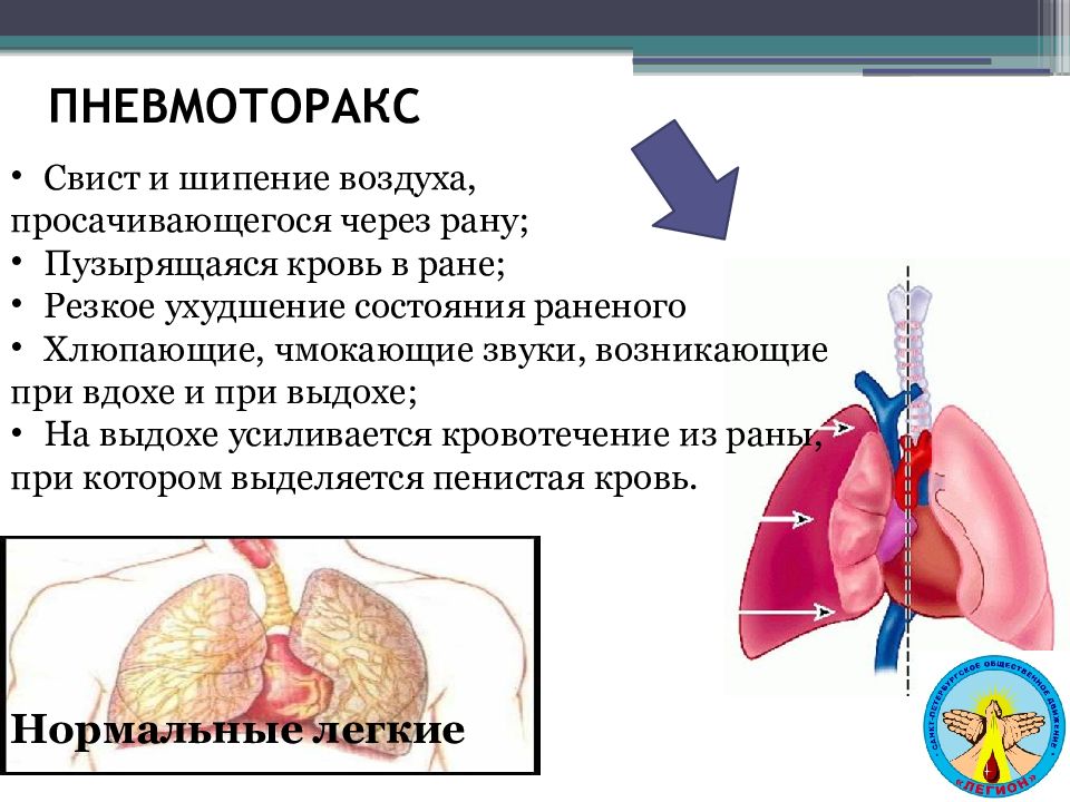 Пневмоторакс картинки для презентации