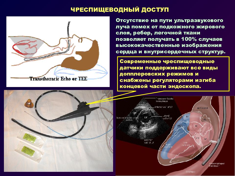 Отзыв эхо. Внутрисердечная эхокардиография. Чреспищеводная ЭХОКГ датчик. Датчик для чреспищеводной эхокардиографии. ЧПЭФИ (чреспищеводное электрофизиологическое исследование.