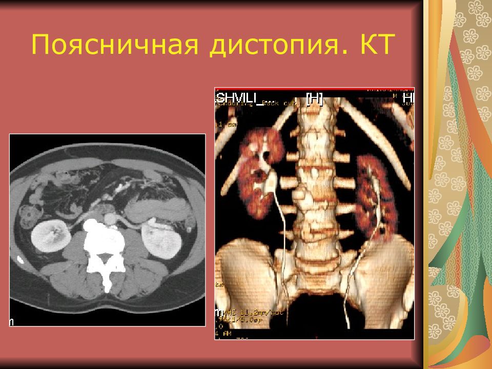 Дистопия почки. Поясничная дистопия почки кт. Поясничная дистопия почки рентген. Тазовая дистопия почки кт.