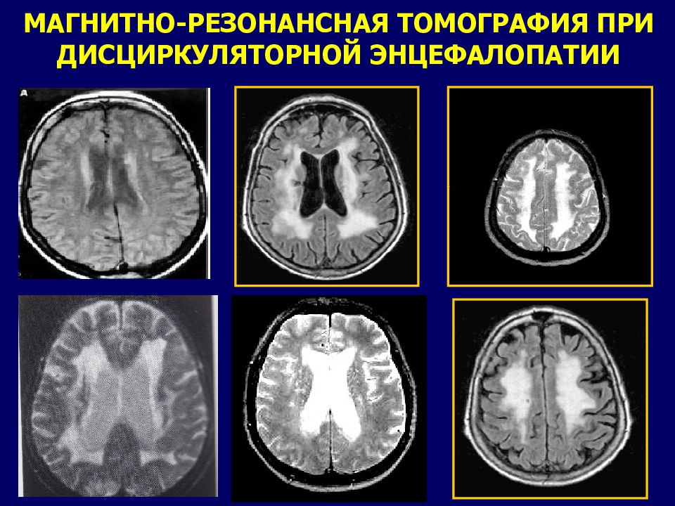 Энцефалопатия вернике мрт картина