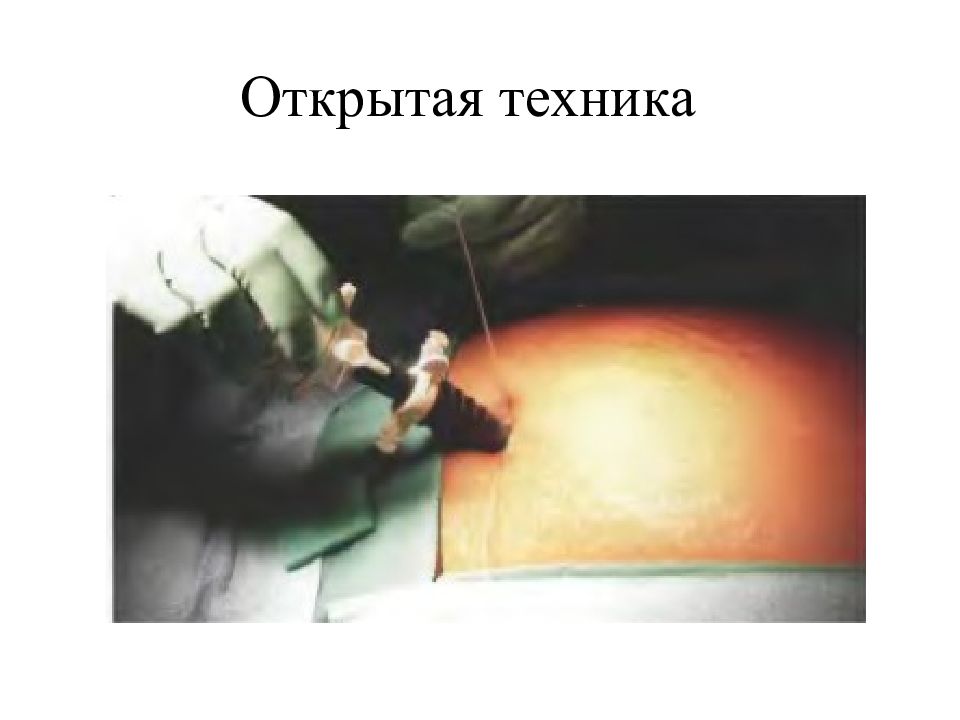 Открытая техника. Эндовидеохирургия презентация. Эндовидеохирургия реферат. Книги по эндовидеохирургии. Руководство по эндовидеохирургии Акимов.