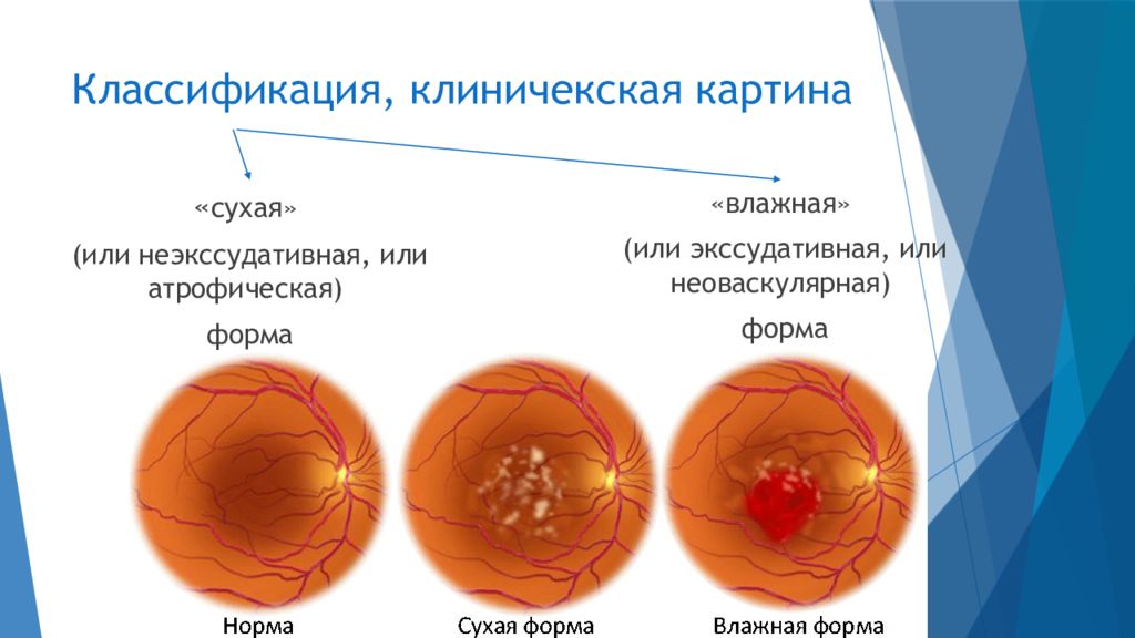 Возрастная макулярная дегенерация презентация