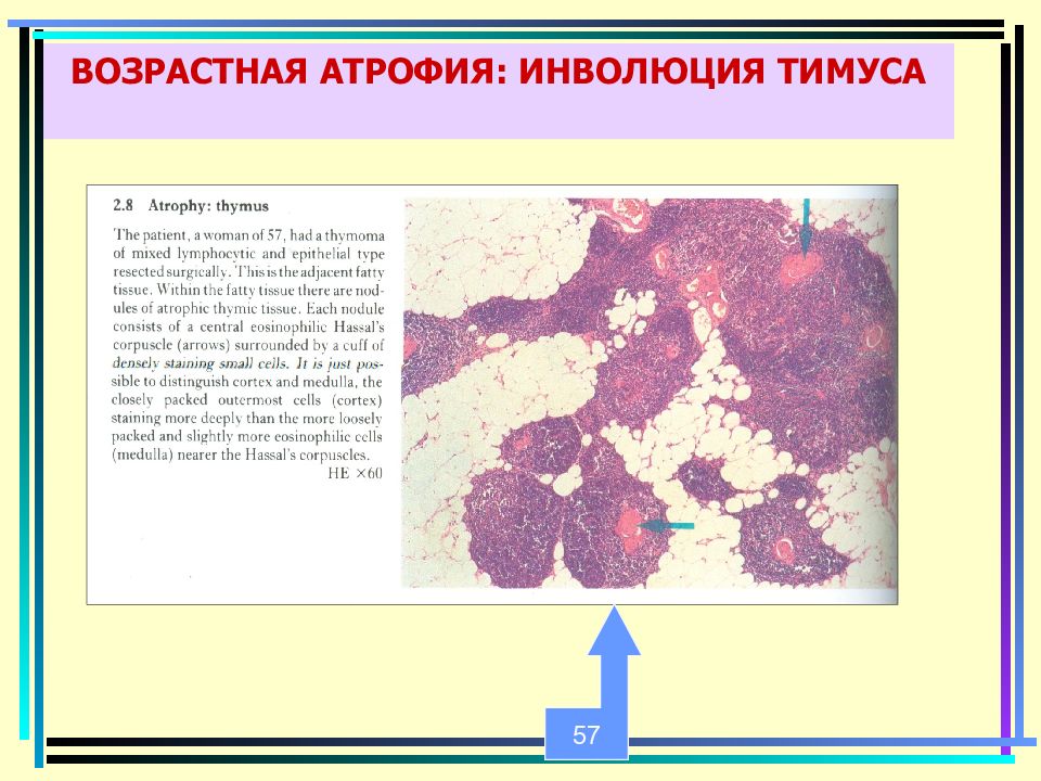 Атрофия презентация патология